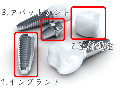 インプラントの構造